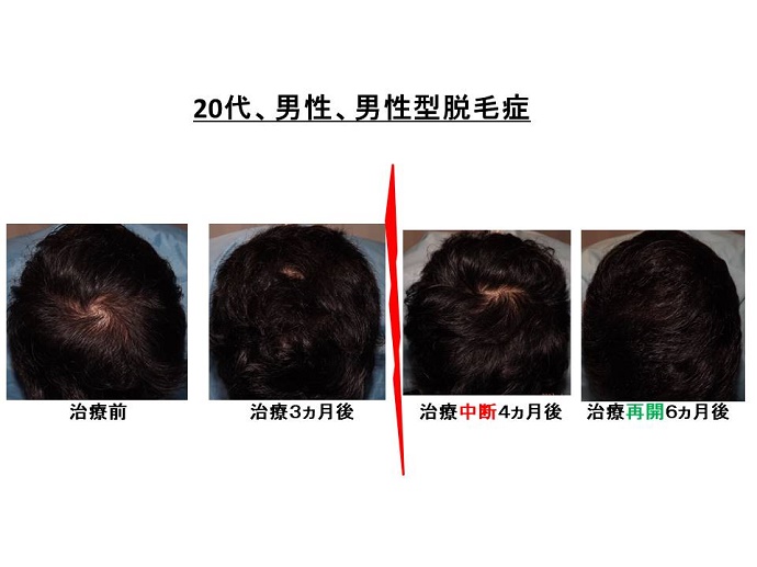 円形脱毛症　病院""